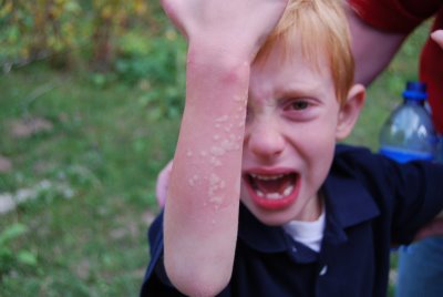 Stinging Nettle- cure-rash